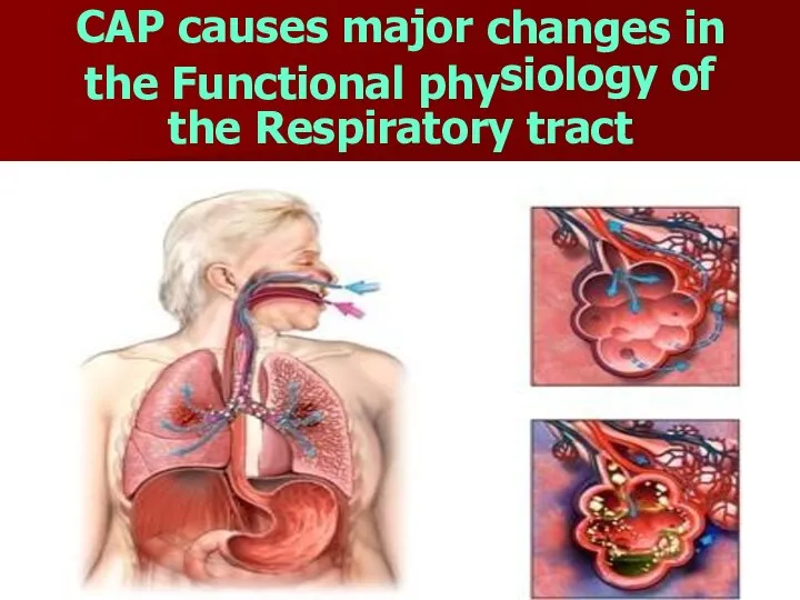 changes in CAP causes major the Functional phy siology of the Respiratory tract