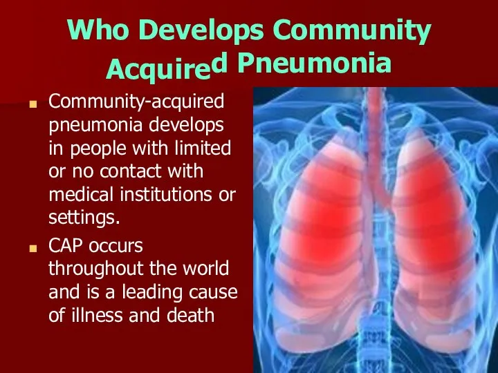 Who Develops Community Acquire d Pneumonia Community-acquired pneumonia develops in people with