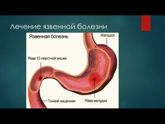 Лечение язвенной болезни