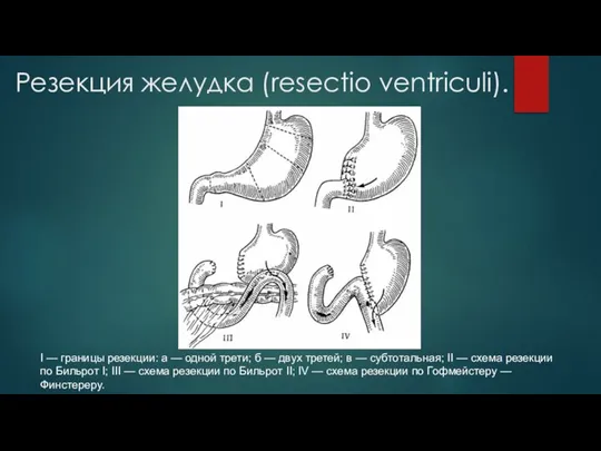 Резекция желудка (resectio ventriculi). I — границы резекции: а — одной трети;