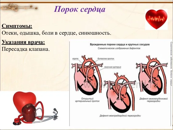 Порок сердца Симптомы: Отеки, одышка, боли в сердце, синюшность. Указания врача: Пересадка клапана.