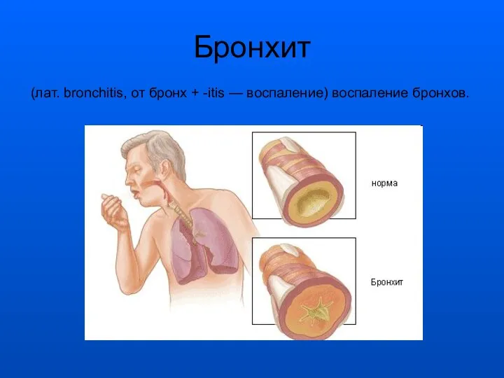 Бронхит (лат. bronchitis, от бронх + -itis — воспаление) воспаление бронхов.