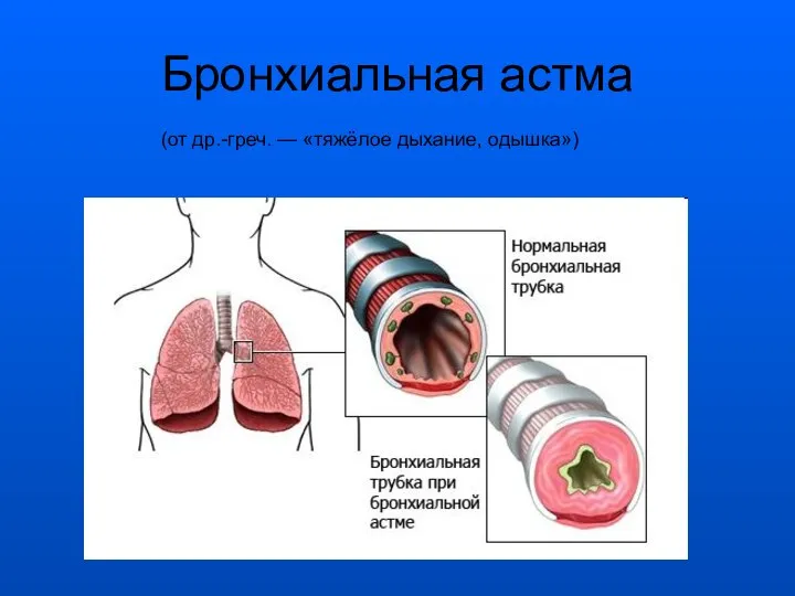 Бронхиальная астма (от др.-греч. — «тяжёлое дыхание, одышка»)