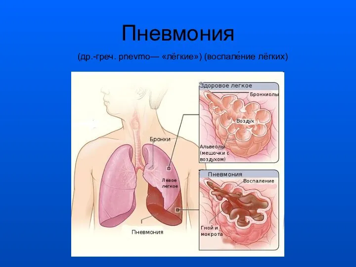 Пневмония (др.-греч. pnevmo— «лёгкие») (воспале́ние лёгких)