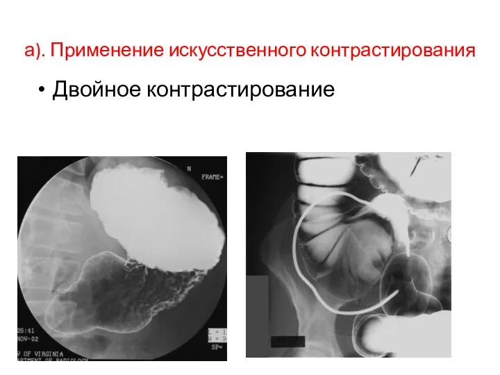 а). Применение искусственного контрастирования Двойное контрастирование