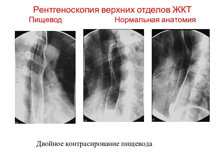 Рентгеноскопия верхних отделов ЖКТ Пищевод Нормальная анатомия Двойное контрасирование пищевода