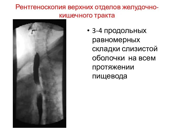 Рентгеноскопия верхних отделов желудочно-кишечного тракта 3-4 продольных равномерных складки слизистой оболочки на всем протяжении пищевода