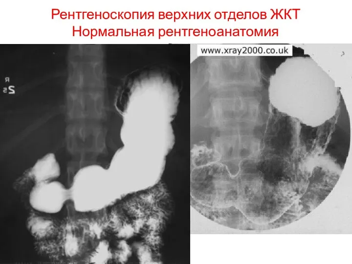 Рентгеноскопия верхних отделов ЖКТ Нормальная рентгеноанатомия