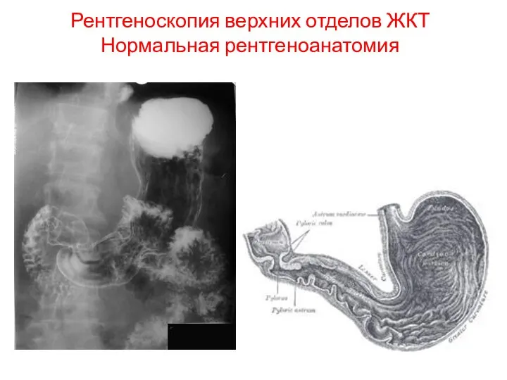 Рентгеноскопия верхних отделов ЖКТ Нормальная рентгеноанатомия