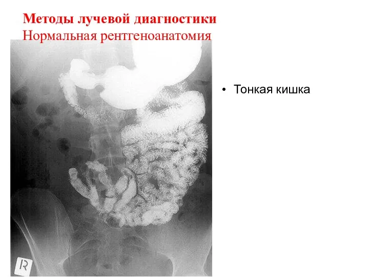 Тонкая кишка Методы лучевой диагностики Нормальная рентгеноанатомия