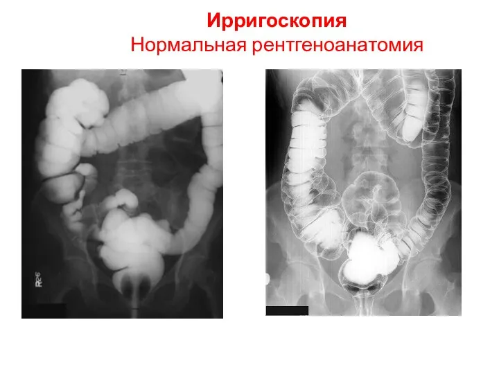 Ирригоскопия Нормальная рентгеноанатомия