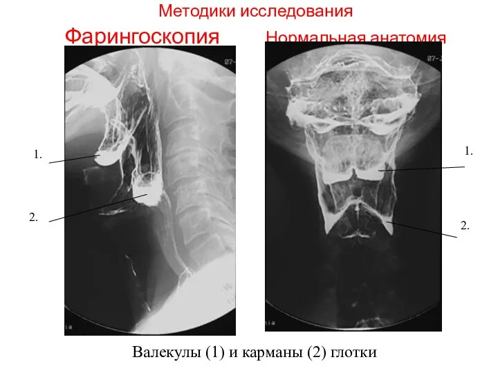 Методики исследования Фарингоскопия Нормальная анатомия 1. 1. 2. 2. Валекулы (1) и карманы (2) глотки