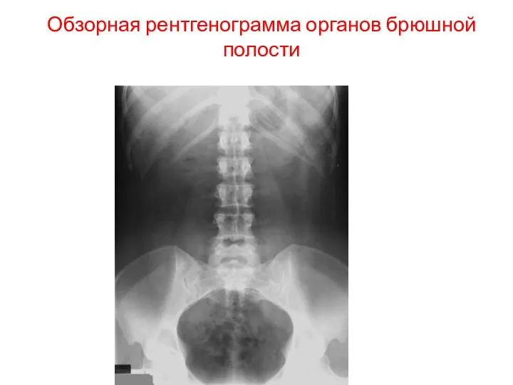 Обзорная рентгенограмма органов брюшной полости