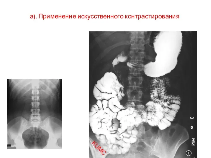 а). Применение искусственного контрастирования