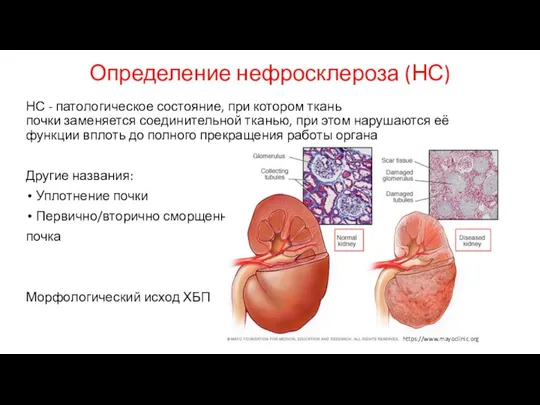 Определение нефросклероза (НС) НС - патологическое состояние, при котором ткань почки заменяется