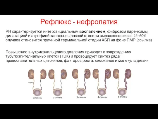 Рефлюкс - нефропатия РН характеризуется интерстициальным воспалением, фиброзом паренхимы, дилатацией и атрофией