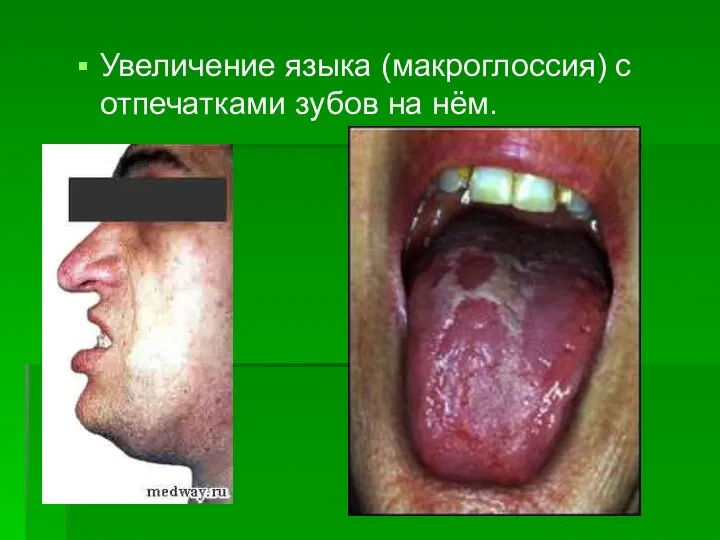 Увеличение языка (макроглоссия) с отпечатками зубов на нём.