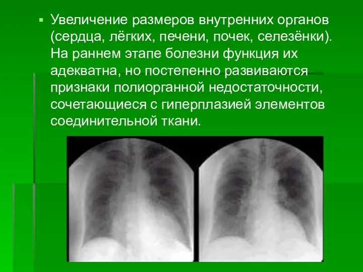 Увеличение размеров внутренних органов (сердца, лёгких, печени, почек, селезёнки). На раннем этапе