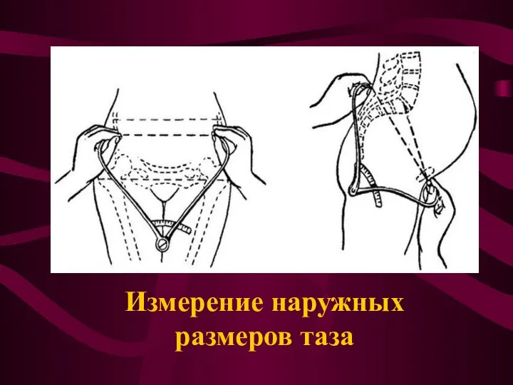 Измерение наружных размеров таза