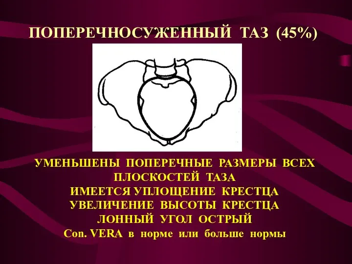 ПОПЕРЕЧНОСУЖЕННЫЙ ТАЗ (45%) УМЕНЬШЕНЫ ПОПЕРЕЧНЫЕ РАЗМЕРЫ ВСЕХ ПЛОСКОСТЕЙ ТАЗА ИМЕЕТСЯ УПЛОЩЕНИЕ КРЕСТЦА