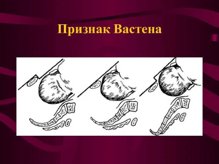 Признак Вастена