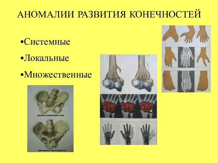 АНОМАЛИИ РАЗВИТИЯ КОНЕЧНОСТЕЙ Системные Локальные Множественные