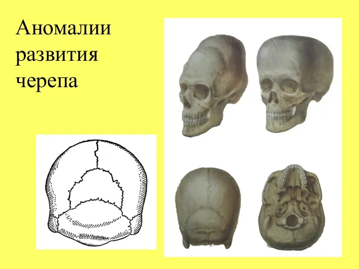 Аномалии развития черепа
