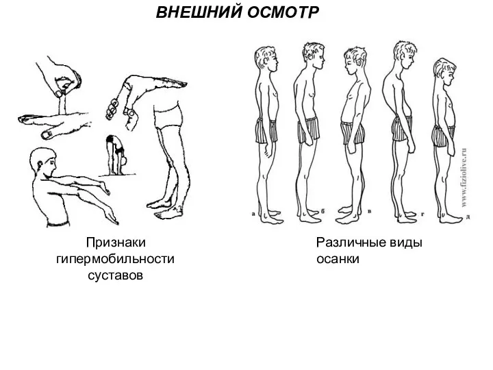 ВНЕШНИЙ ОСМОТР Признаки гипермобильности суставов Различные виды осанки