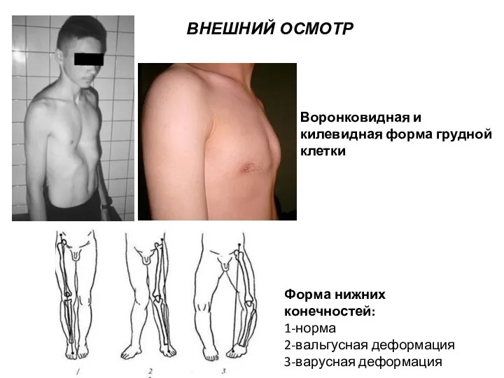 ВНЕШНИЙ ОСМОТР Воронковидная и килевидная форма грудной клетки Форма нижних конечностей: 1-норма 2-вальгусная деформация 3-варусная деформация