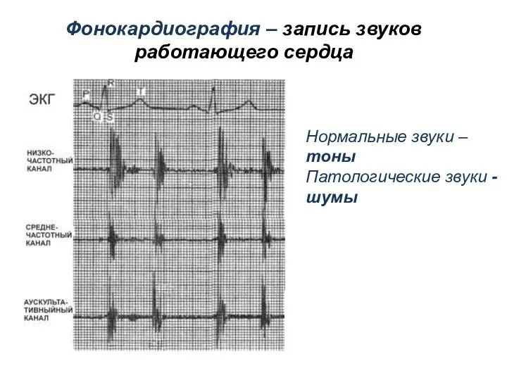 Фонокардиография – запись звуков работающего сердца Нормальные звуки – тоны Патологические звуки - шумы