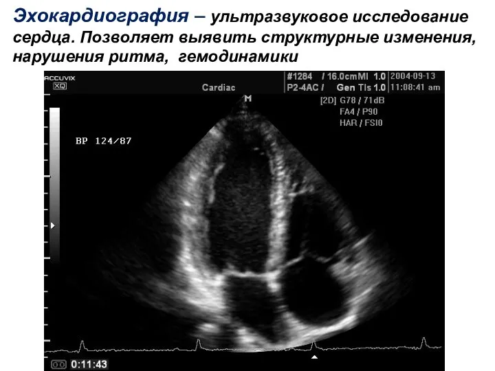 Эхокардиография – ультразвуковое исследование сердца. Позволяет выявить структурные изменения, нарушения ритма, гемодинамики