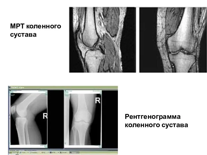 МРТ коленного сустава Рентгенограмма коленного сустава