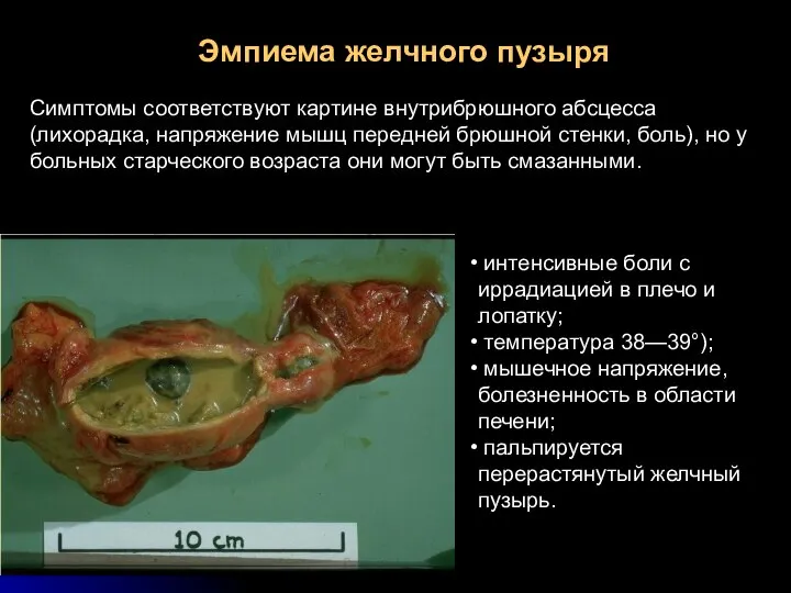 Эмпиема желчного пузыря Симптомы соответствуют картине внутрибрюшного абсцесса (лихорадка, напряжение мышц передней