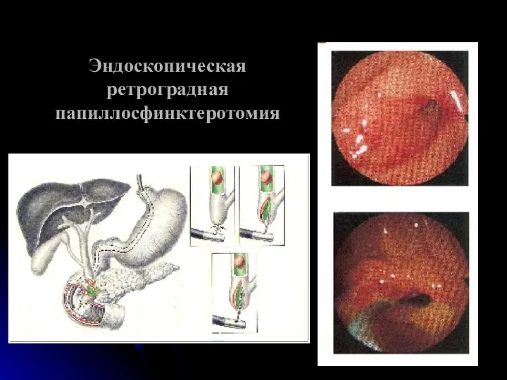 Эндоскопическая ретроградная папиллосфинктеротомия
