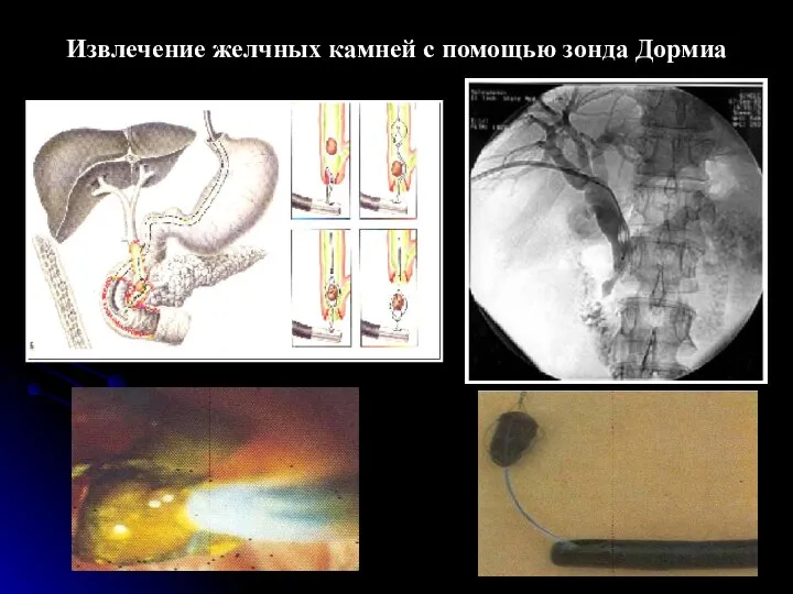 Извлечение желчных камней с помощью зонда Дормиа