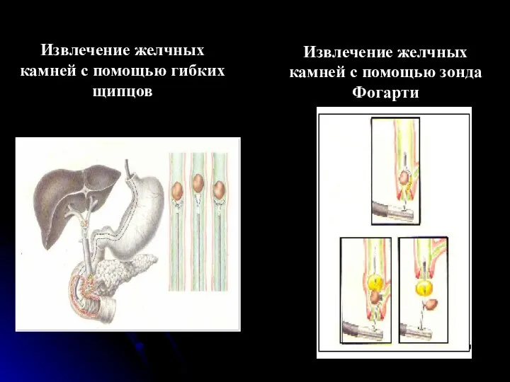 Извлечение желчных камней с помощью гибких щипцов Извлечение желчных камней с помощью зонда Фогарти