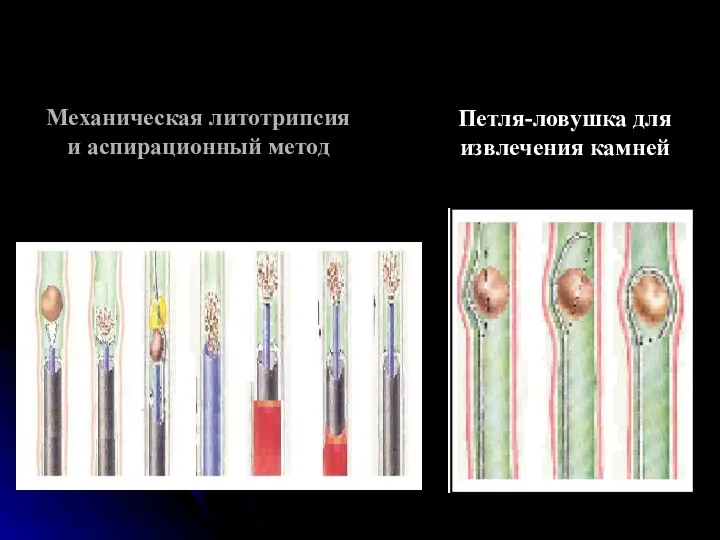 Механическая литотрипсия и аспирационный метод Петля-ловушка для извлечения камней