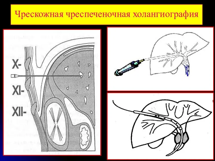 Чрескожная чреспеченочная холангиография