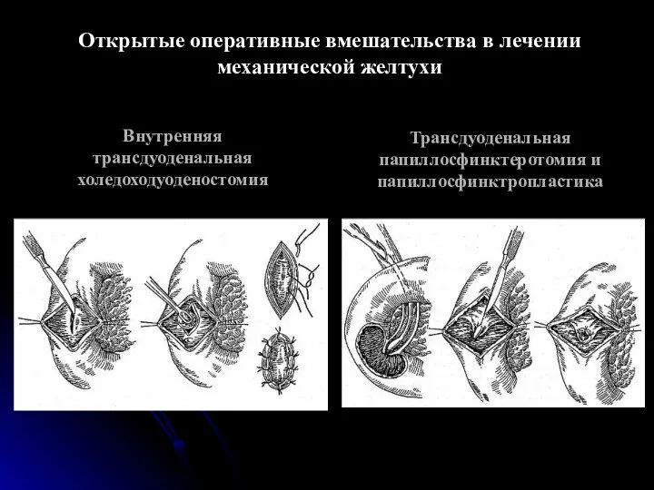 Открытые оперативные вмешательства в лечении механической желтухи Внутренняя трансдуоденальная холедоходуоденостомия Трансдуоденальная папиллосфинктеротомия и папиллосфинктропластика