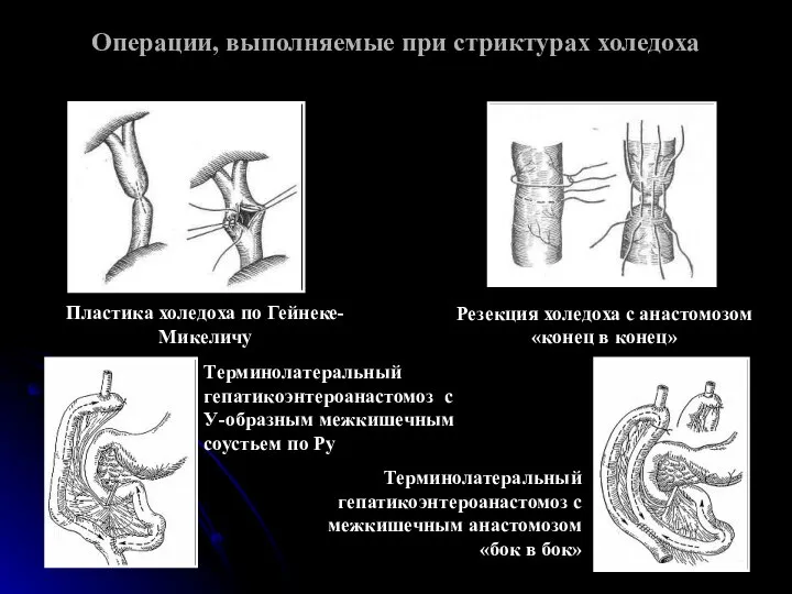 Операции, выполняемые при стриктурах холедоха Пластика холедоха по Гейнеке-Микeличу Резекция холедоха с