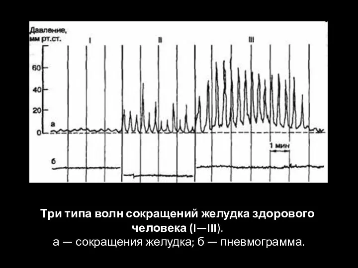 Три типа волн сокращений желудка здорового человека (I—III). а — сокращения желудка; б — пневмограмма.