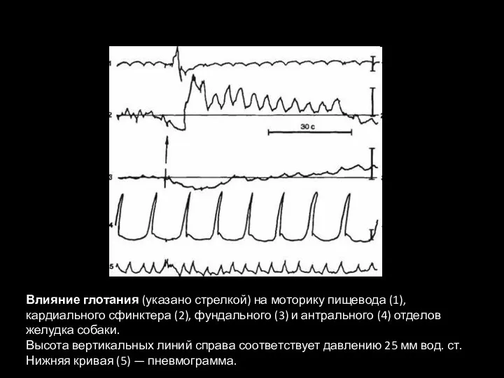 Влияние глотания (указано стрелкой) на моторику пищевода (1), кардиального сфинктера (2), фундального