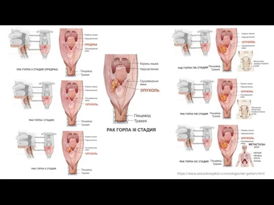 https://www.assutahospital.ru/oncologia/rak-gortani.html