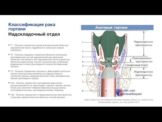 Надскладочный отдел Т1 - Опухоль ограничена одной анатомической областью надсвязочной части, подвижность