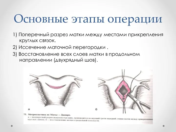 Основные этапы операции 1) Поперечный разрез матки между местами прикрепления круглых связок.