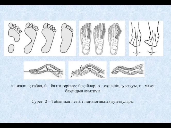 а – жалпақ табан, б – балға тәріздес бақайлар, в – өкшенің