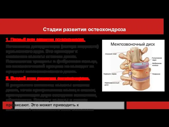 1. Первый этап развития остеохондроза. Начинается дегидратация (потеря жидкости) пульпозного ядра. Это