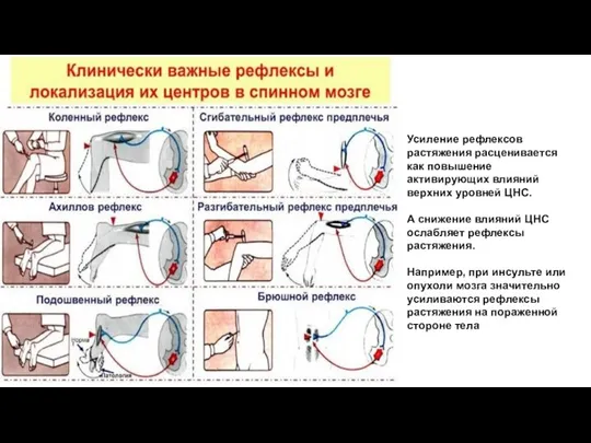 Усиление рефлексов растяжения расценивается как повышение активирующих влияний верхних уровней ЦНС. А