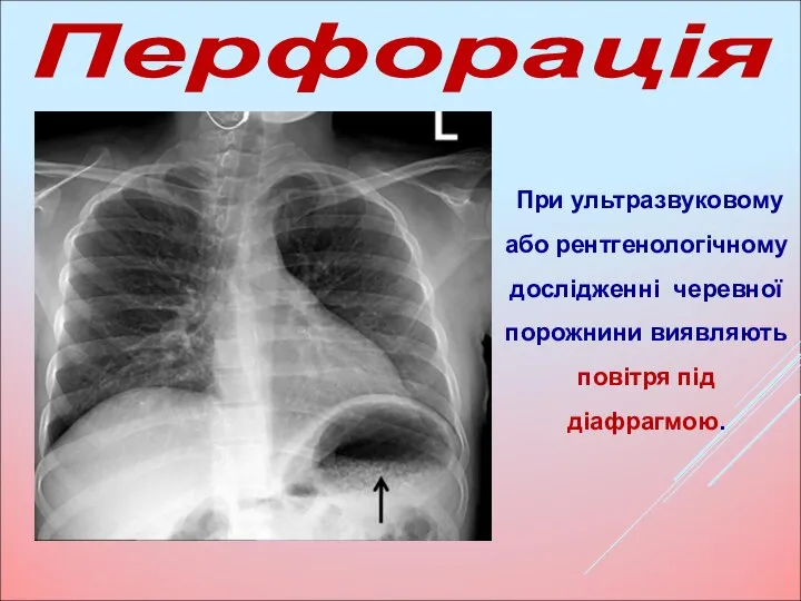 При ультразвуковому або рентгенологічному дослідженні черевної порожнини виявляють повітря під діафрагмою. Перфорація