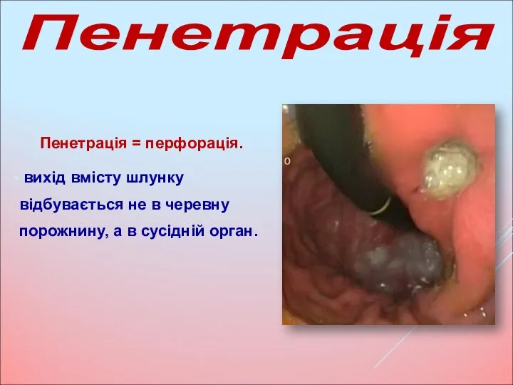 Пенетрація = перфорація. вихід вмісту шлунку відбувається не в черевну порожнину, а в сусідній орган. Пенетрація